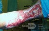 Atrophic Lower Leg Ulceration - Stage I