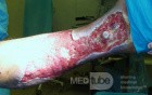 Atrophic Lower Leg Ulceration - Stage I