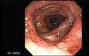 Ulcerative Colitis Complicating Pseudomembranous Colitis (2 of 4)