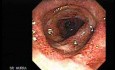 Ulcerative Colitis Complicating Pseudomembranous Colitis (2 of 4)
