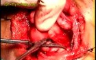 Warthin's tumor