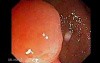 Giant Tubulo - Villous Adenoma (2 of 17)