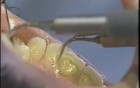 best way to have your teeth cleaned