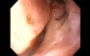 Massive Epistaxis - After Alcohol Ablation Status - 8/8