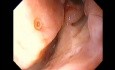 Massive Epistaxis - After Alcohol Ablation Status - 8/8