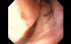 Massive Epistaxis - After Alcohol Ablation Status - 8/8