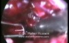 Complicated gastric band treatment