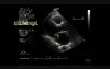 Infective Endocarditis on Mitral Stenosis 1