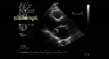 Infective Endocarditis on Mitral Stenosis 1
