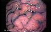 Scirrhous Gastric Carcinoma - Endoscopy (3 of 15)