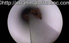 How to Remove The Hardened Crusts From a Blocked T-Tube