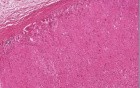 Amyloidosis - Adrenal gland - Histopathology