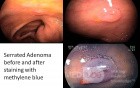 Serrated adenoma