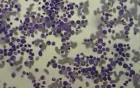 Bone Marrow Smear