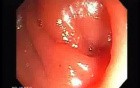 Hereditary Hemorrhagic Telangiectasia (Osler-Weber-Rendu syndrome) (4 of 7)