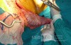 Adenocarcinoma of the cardias and gastric fundus with signet-ring cells (5 of 25)