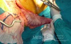 Adenocarcinoma of the cardias and gastric fundus with signet-ring cells (5 of 25)