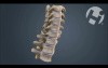Volumated C7-T1 Subluxation Fracture