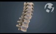 Volumated C7-T1 Subluxation Fracture