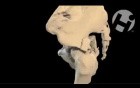 Volumated Pelvic Fractures