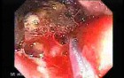 Multiple Adenomatous Polyps Of The Rectum (29 of 37)