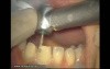 Initial Preparation For Aesthetic Veneers (3/4)