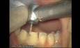 Initial Preparation For Aesthetic Veneers (3/4)