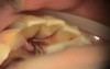 Root Resorption Treatment - Geristore