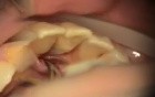 Gerestore Repair Of Root Resorption