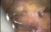 Robotic Total Mesorectal Excision - Practical Solution