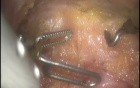 Robotic Total Mesorectal Excision - Practical Solution