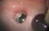Implant Repair, Lower Right