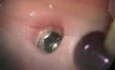 Implant Repair, Lower Right