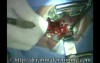 Tonsillectomy by Dissection Method