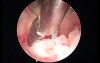 Hysteroscopic biopsy and endometrial vaporization