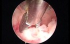 Hysteroscopic biopsy and endometrial vaporization