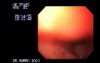 Adenocarcinoma of the Stomach And Esophagus - Endoscopy