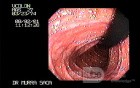 Familial Adenomatous Polyposis of the Colon (14 of 30)