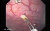 Juvenile Non Familial Polyposis of the Colon (35 of 37)