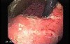 Synchronous Cancer Gastric and Esophageal (3 of 9 )