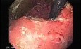 Synchronous Cancer Gastric and Esophageal (3 of 9 )