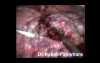 Laparoscopic liver resection of HCC - male patient