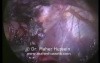 Laparoscopic Revision of Gastric Bypass