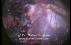 Laparoscopic Revision of Gastric Bypass