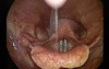 Laryngeal Tremors