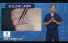 New Laser Treatment for Toenail Fungus