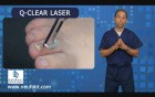 New Laser Treatment for Toenail Fungus