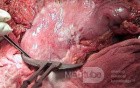 Plastic Linitis with bilateral Krukenberg´s tumor (3 of 13)
