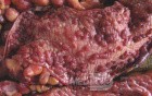 Multiple Rectal Ulcers (100 of 110)