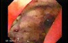 Adenocarcinoma of the Antrum with Duodenal Infiltration (1 of 3)